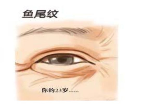 为什么会长鱼尾纹呢 怎么样可以消除鱼尾纹呢