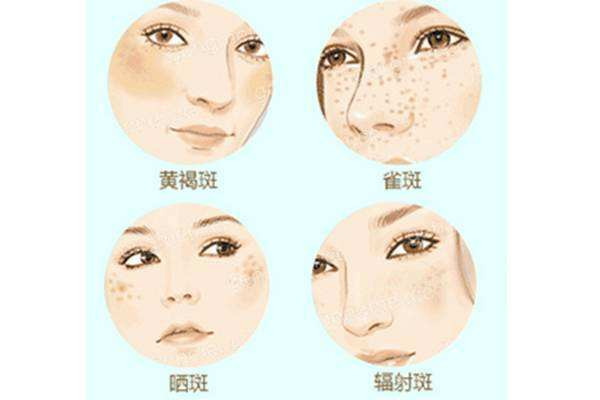 光子祛斑的原理 光子祛斑有副作用吗