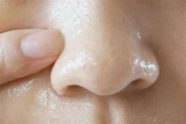 阿奴去黑头精油怎么样 阿奴去黑头精油有用吗 阿奴去黑头精油怎么样 阿奴去黑头精油有用吗