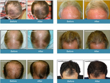 hairmax激光生发梳有用吗?hairmax激光生发梳怎么样?
