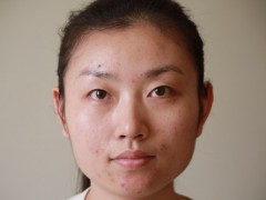 去除痘印的12个小偏方