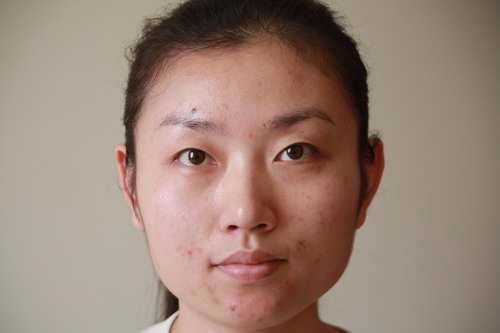 去除痘印的12个小偏方 去除痘印的12个小偏方