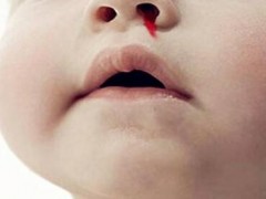 小孩流鼻血的原因是什么 流鼻血的三大原因及预防方法