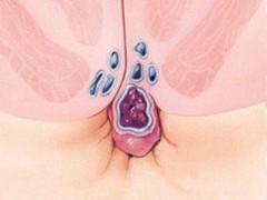 严重的脱肛怎么治疗   这三种治疗方法值得一试