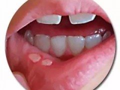 口腔溃疡吃什么药好的最快 教你快速解决