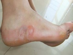 脚底水泡是怎么回事 竟是鞋子不合脚惹的祸
