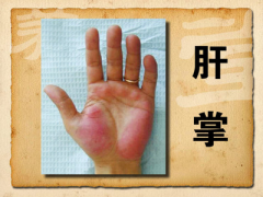 什么是肝掌 专家全面讲解肝掌知识