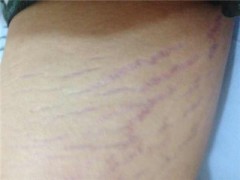 紫纹怎么消除 了解种类快速解决