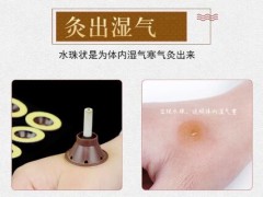 为什么拔火罐后皮肤会黑紫 难道是湿气过重？