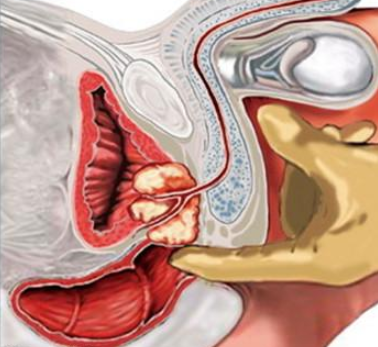前列腺的按摩方法 前列腺病自我按摩【圖解】_美健品招商網
