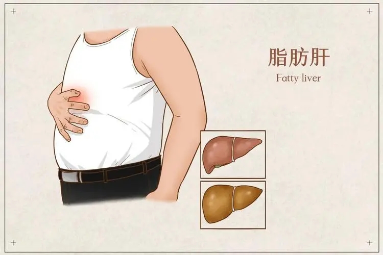 脂肪肝.webp