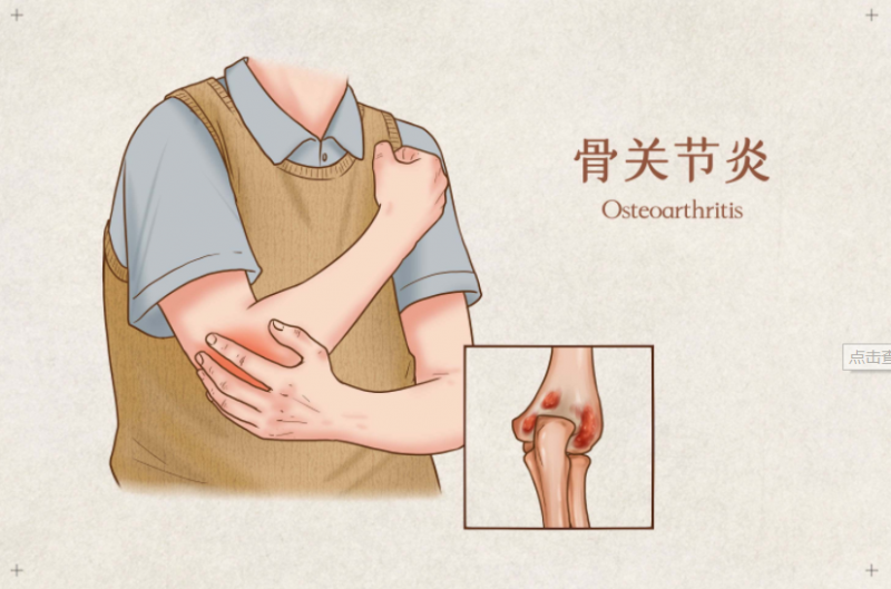 关节炎