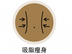 手术吸脂40斤要多少钱 吸脂术后的注意事项有哪些