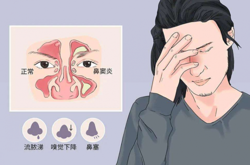 鼻炎