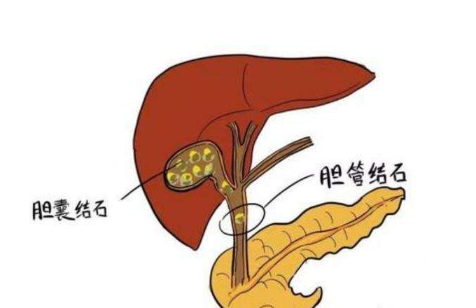 胆结石怎么治最好 胆结石的最佳治疗方法