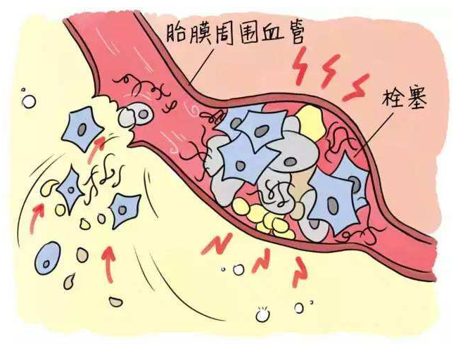 羊水栓塞