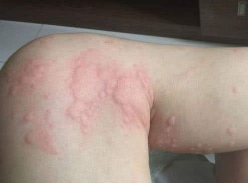 螨虫过敏症状