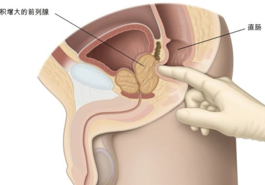 前列腺