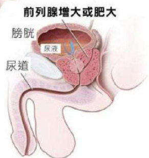 前列腺