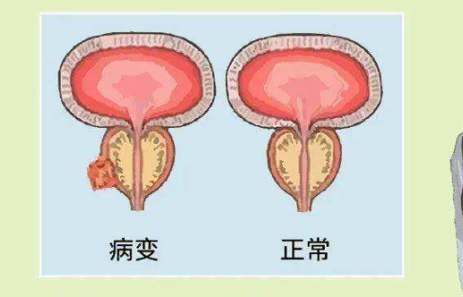前列腺