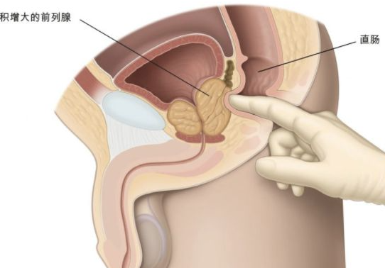 慢性前列腺炎中医食疗防治前列腺炎