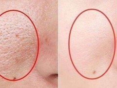 鼻子毛孔粗大怎么办