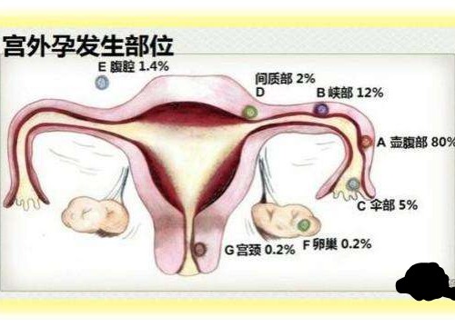 原因导致宫外孕?