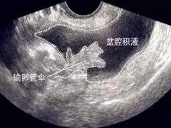 宫腔积液是怎么回事