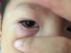 眼角膜发炎怎么办
