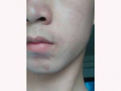 脸颊长痘是哪里不好