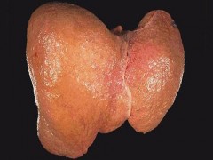 肝硬化什么症状