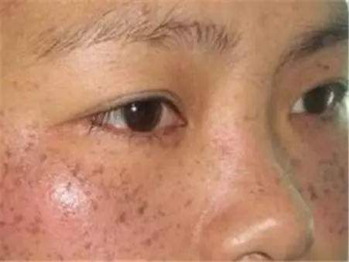 为什么会长黄褐斑