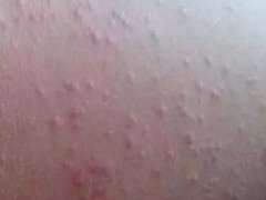 肝病的初期症状