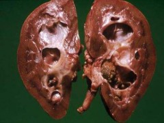 肾结石饮食注意什么