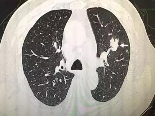Pulmo<em></em>nary nodule