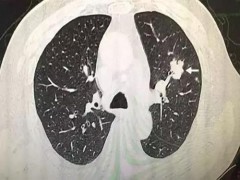 肺上有结节是怎么回事