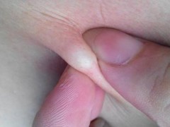 脂肪瘤怎么去除小窍门