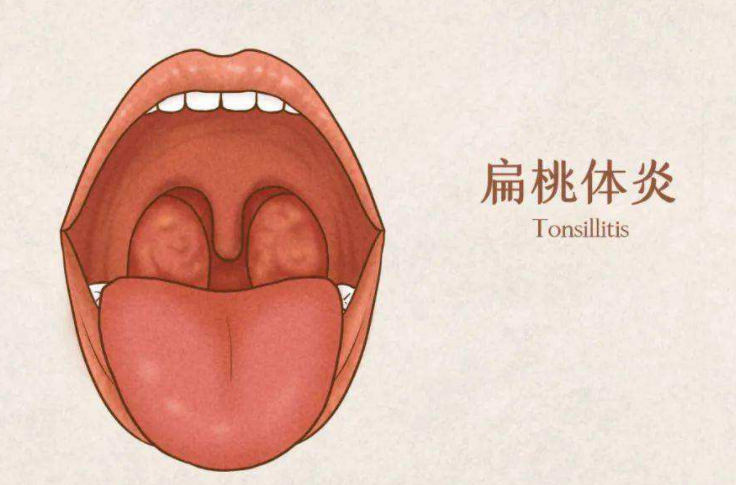 扁桃体发炎