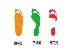 扁平足怎么判断