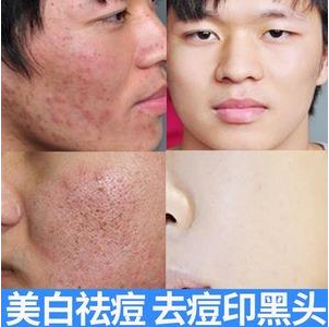 男士祛痘护肤品