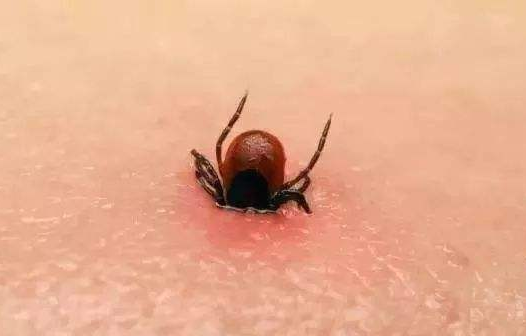 蜱虫叮咬症状