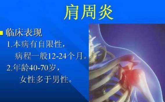 肩周炎