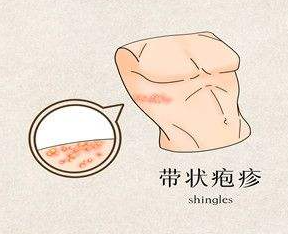 疱疹