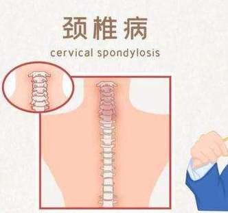 颈椎病头晕?&euro;么办 颈椎病症???