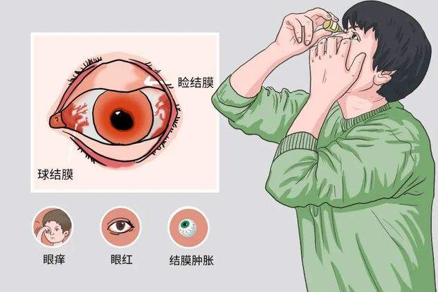 结膜炎