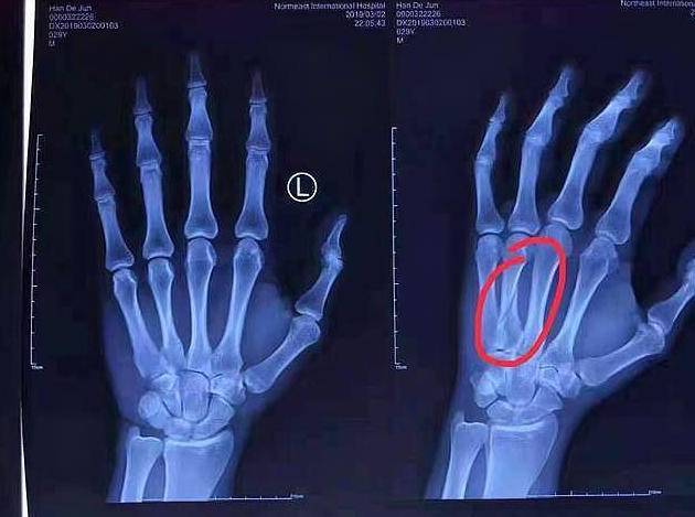 手指骨裂