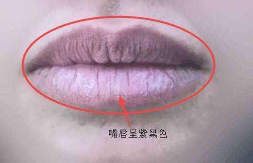 嘴唇黑紫色