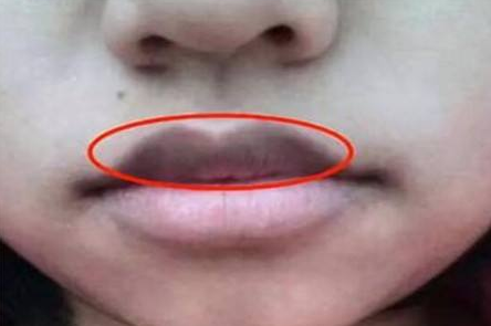 嘴唇黑怎么回事