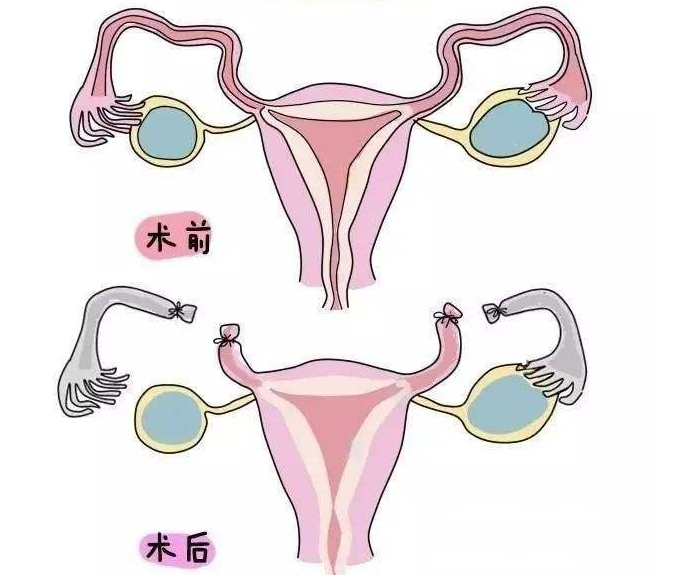 结扎了还能生吗