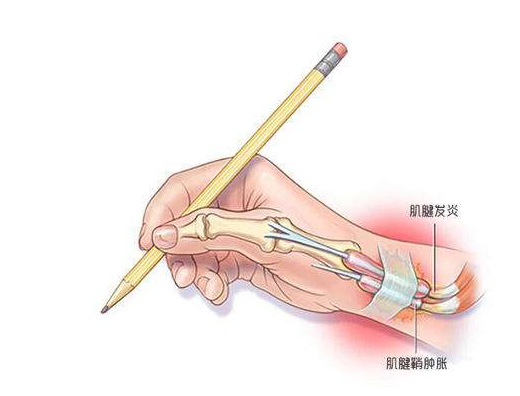 肌腱炎的症状